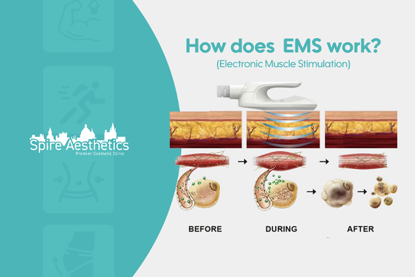 EMS treatment for post pregnancy weight loss treatment Rushden