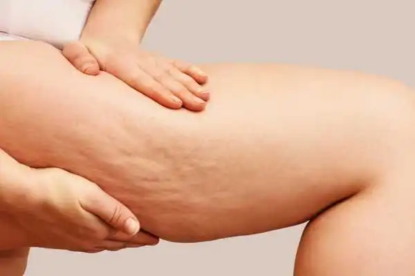 Image of woman showing leg with cellulite Rushden