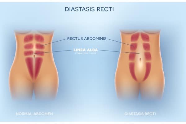 What Non-Surgical Options Are Available for Diastasis Recti Rushden?