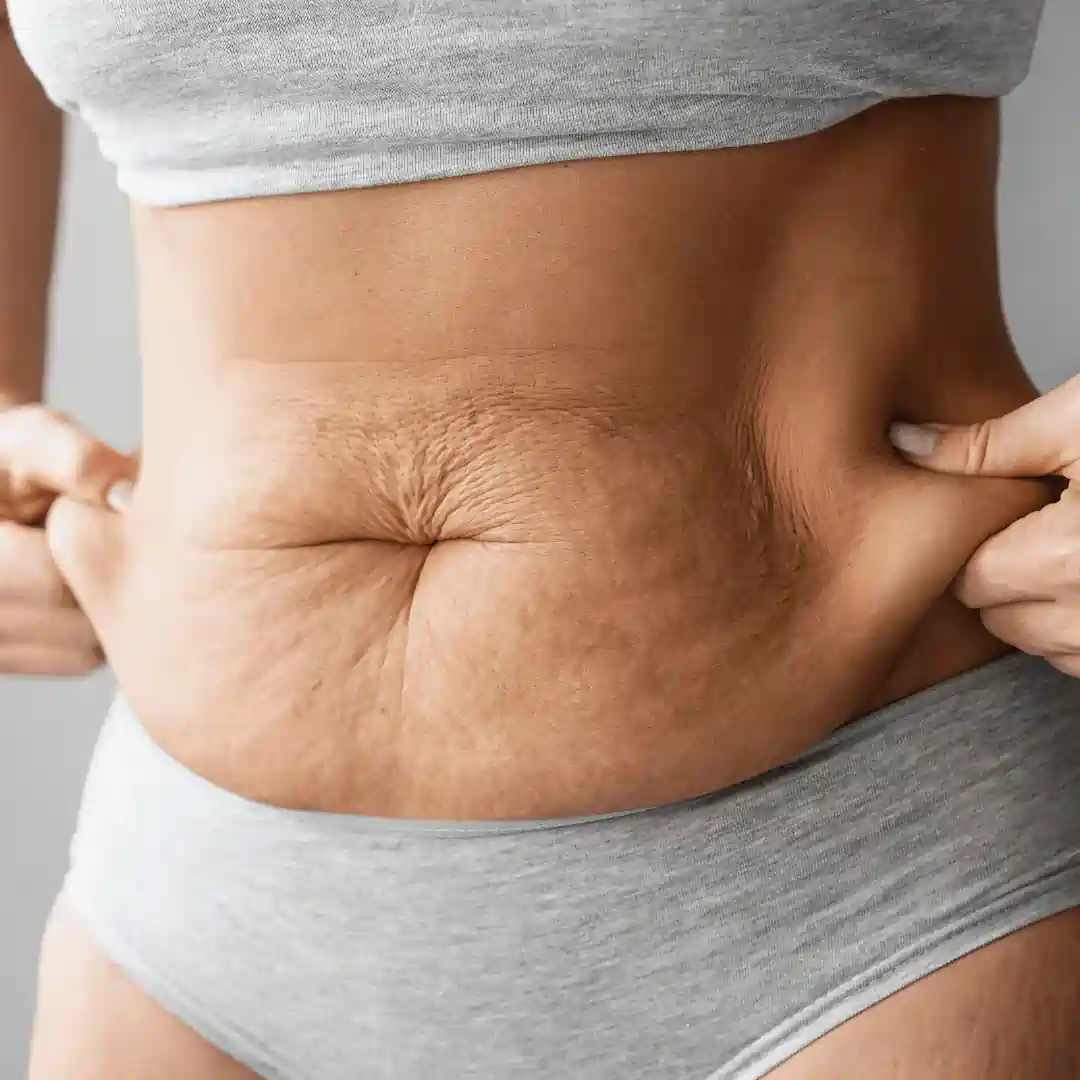 Is It Normal to Have Loose Skin After Pregnancy Rushden?
