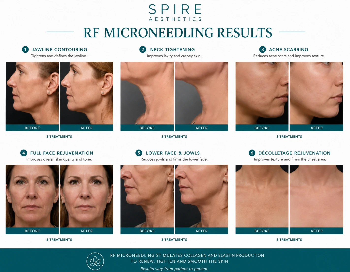 RF Microneedling Skin tightening Rushden results
