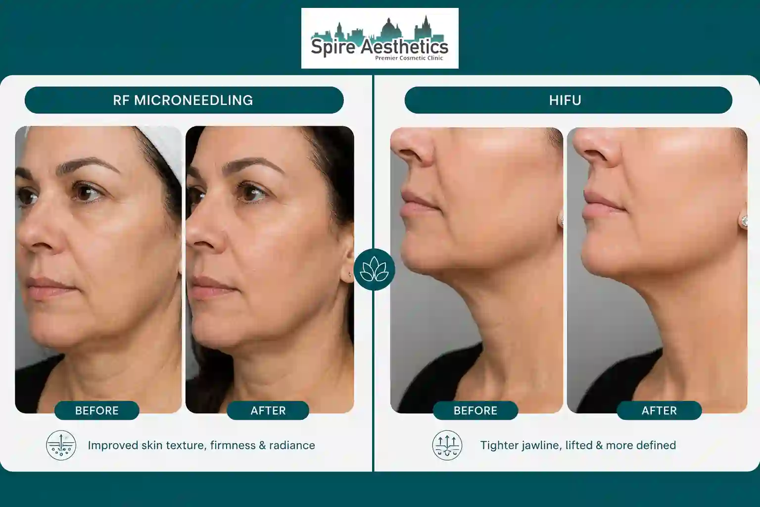 Can RF Microneedling and HIFU Be Combined Rushden?