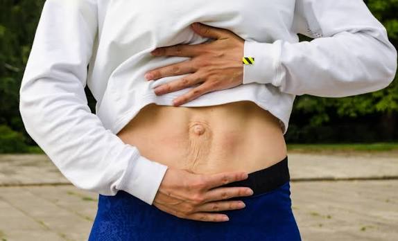 When Could Diastasis Recti Be the Missing Piece of the Puzzle Rushden?