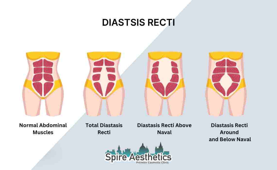 Is Non-Surgical Diastasis Recti Treatment Right for You? Common Concerns Answered Rushden